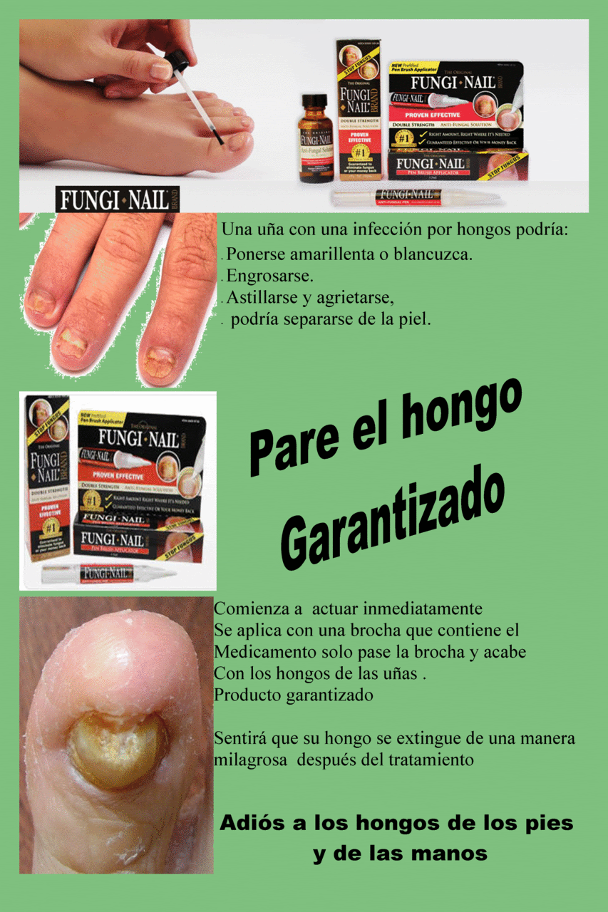 El análogo barato del hongo sobre la uña de los pies